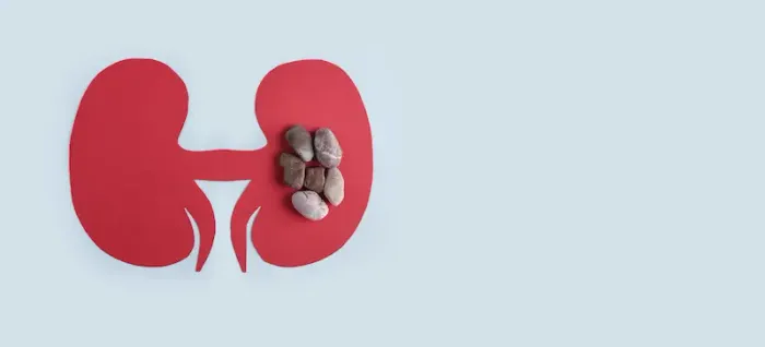Kidney Stones Myths: Debunking Common Misconceptions